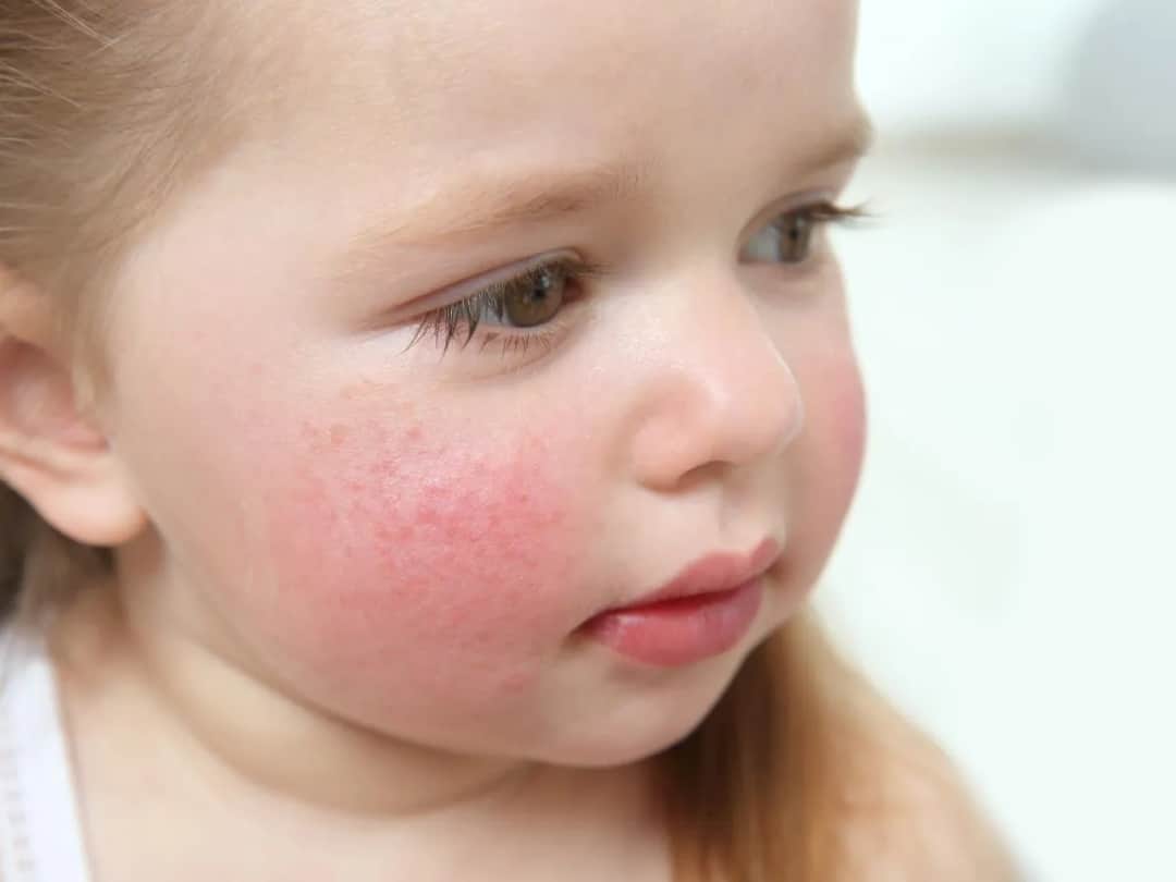 Czerwone policzki u dziecka: 7 skutecznych sposobów leczenia