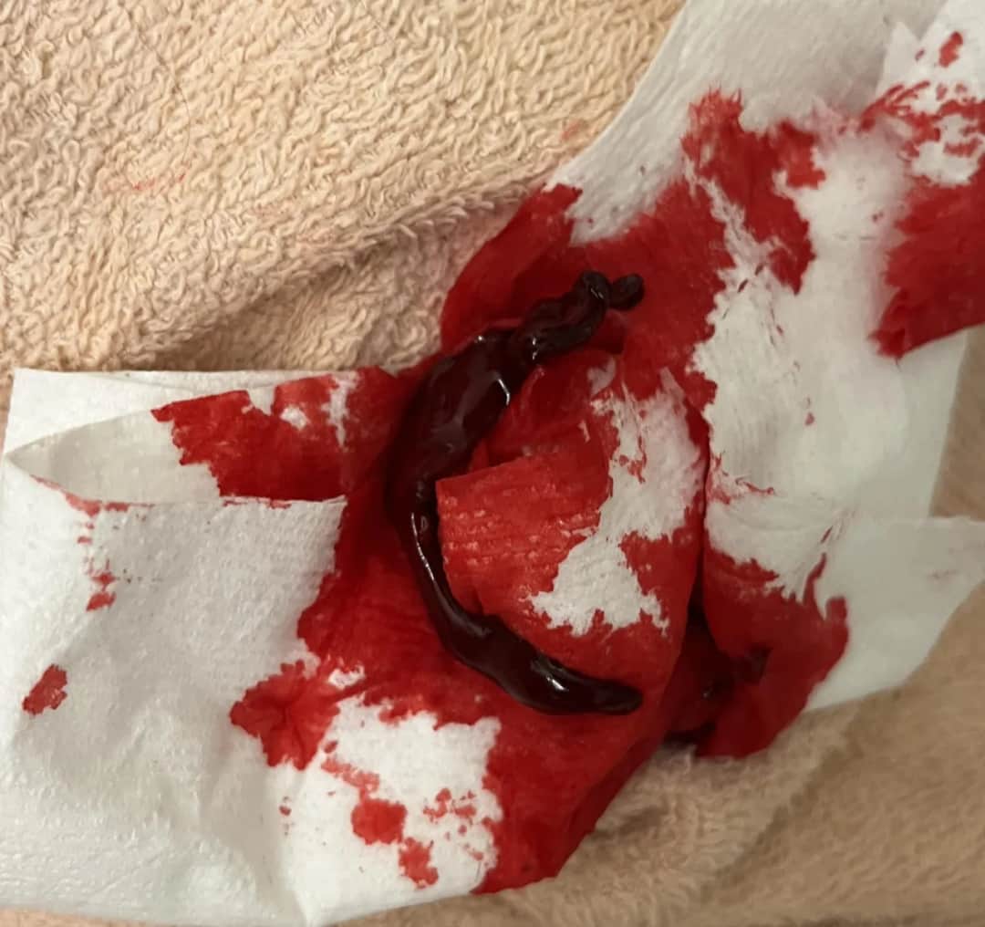 Jak długo utrzymują się skrzepy po porodzie? Ważne informacje dla zdrowia