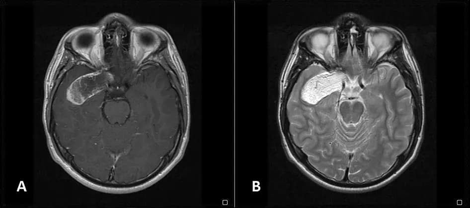 Czy torbiel u niemowlaka się wchłonie? Prawda o cystach i ich losie